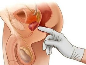 Μασάζ προστάτη για τη θεραπεία της προστατίτιδας στους άνδρες