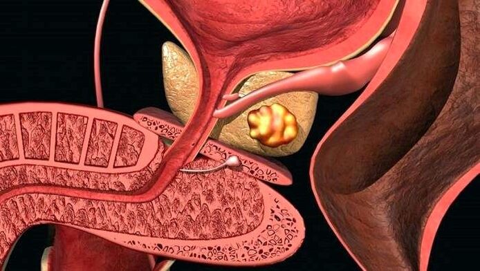 Εναπόθεση λίθων στον προστάτη στην ασβεστώδη προστατίτιδα